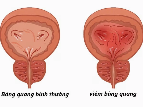 Đậu đen chữa đi tiểu nhiều lần