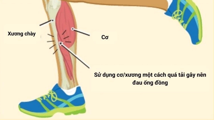 Đau ống đồng khi chạy bộ