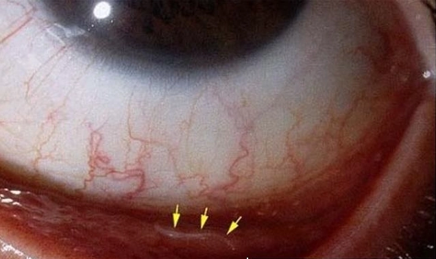 ấu trùng sán chó gây viêm mắt