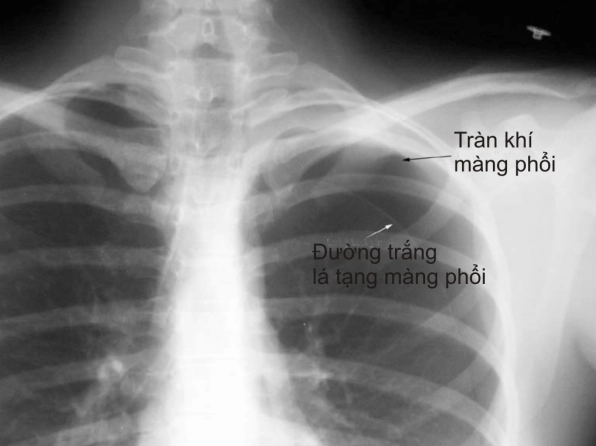 Bác sĩ đang thực hiện đặt ống dẫn lưu màng phổi