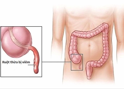 Biểu hiện đau khi bị viêm ruột thừa