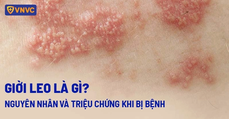 Biểu hiện ban đầu của bệnh giời leo