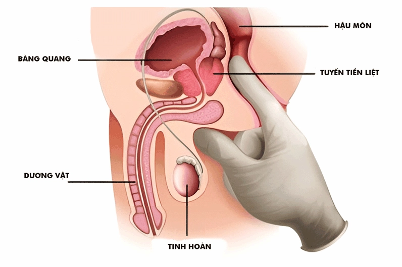 Biểu đồ so sánh các bệnh lý tuyến tiền liệt thường gặp