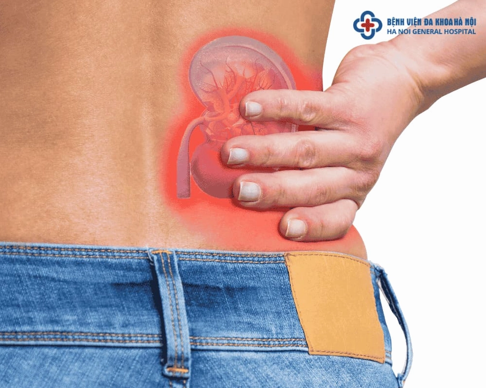 Biểu đồ vị trí đau sỏi thận