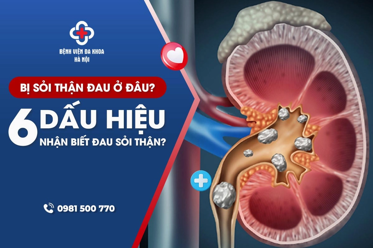 Các dấu hiệu nhận biết sỏi thận