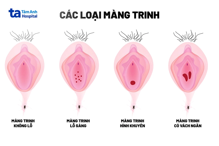 Các hình dạng khác nhau của màng trinh