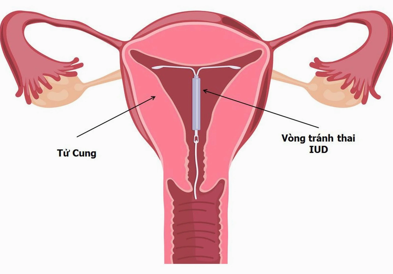 Các loại vòng tránh thai