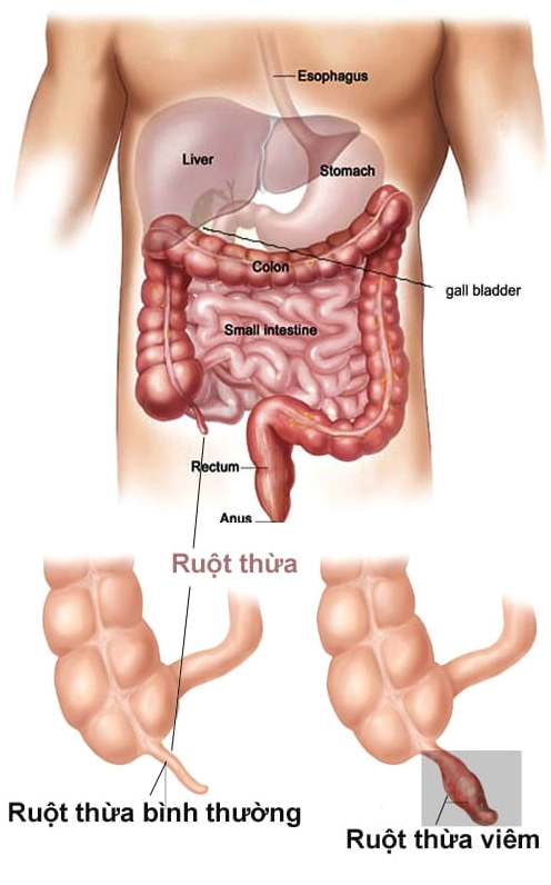 Cảnh báo đau bụng nghi viêm ruột thừa