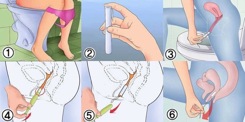 Cấu tạo và nguyên lý hoạt động của tampon