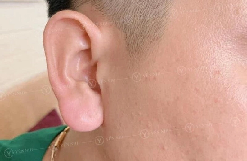Dái tai đầy đặn của người giàu có