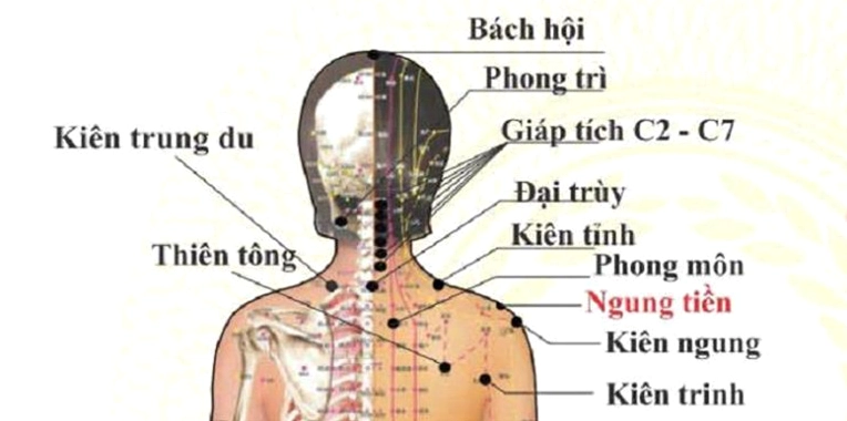 Giác hơi huyệt Đại Chùy