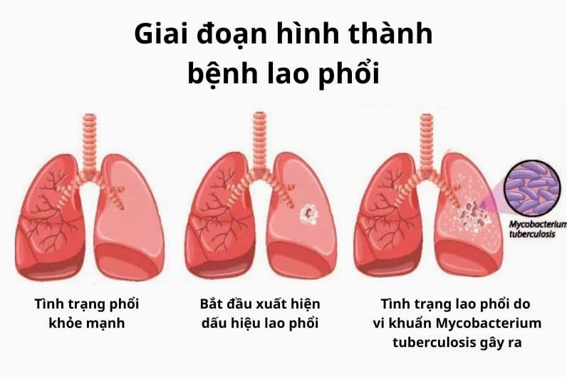 Hình ảnh bác sĩ đang xem kết quả X-quang phổi