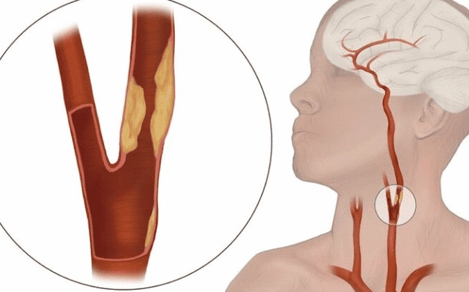 Hình ảnh hẹp động mạch cảnh
