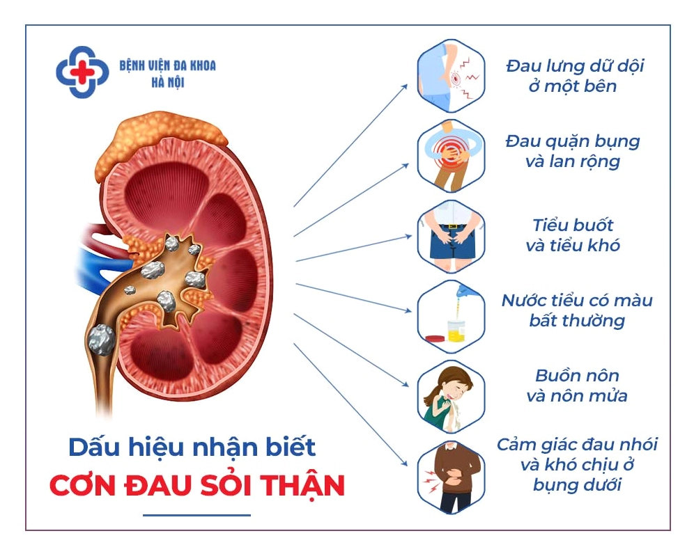 Hình ảnh minh họa bệnh sỏi thận