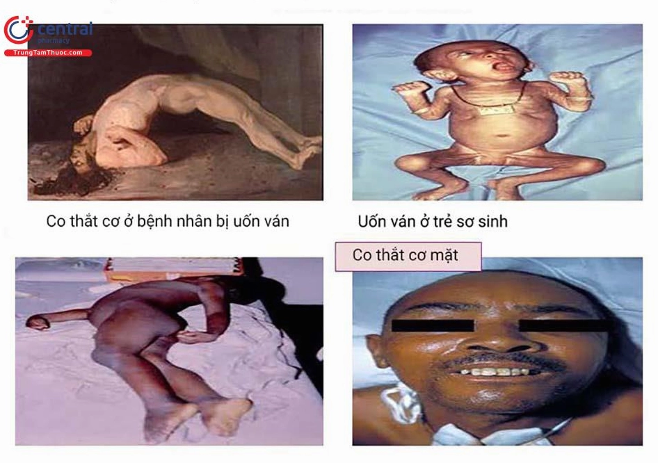 Hình ảnh minh họa biến chứng của bệnh uốn ván