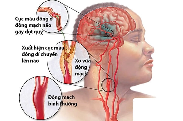 Hình ảnh minh họa can thiệp động mạch cảnh