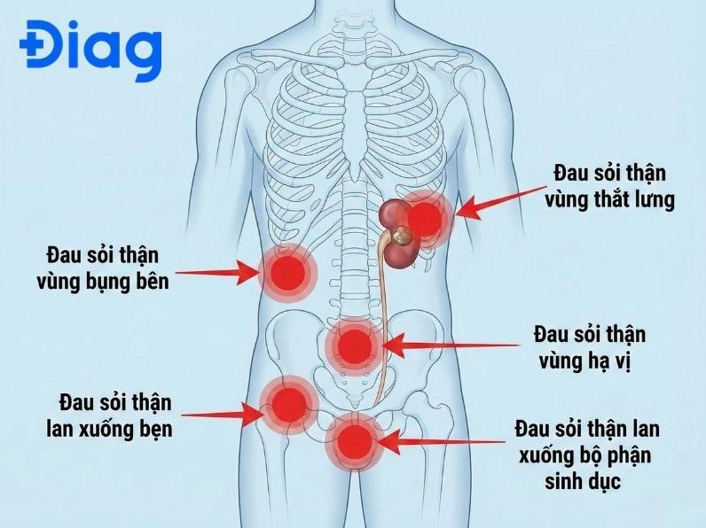 Hình ảnh minh họa cơn đau do sỏi thận lan xuống