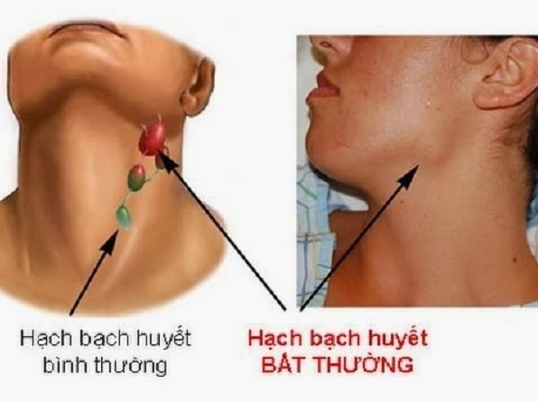 Hình ảnh minh họa hạch bạch huyết bị sưng