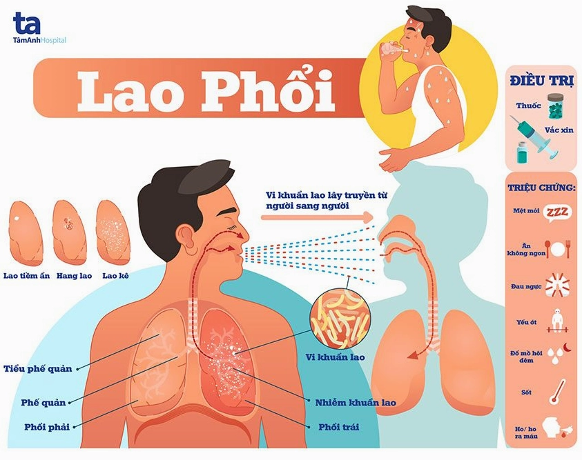Hình ảnh minh họa phổi bị ảnh hưởng bởi bệnh lao
