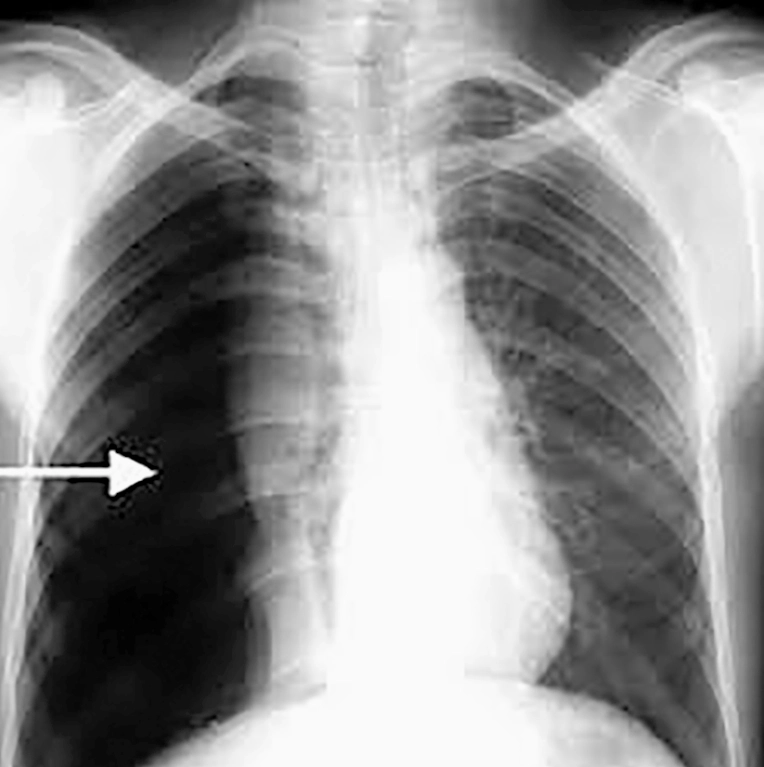 Hình ảnh minh họa phổi bị xẹp do tràn khí