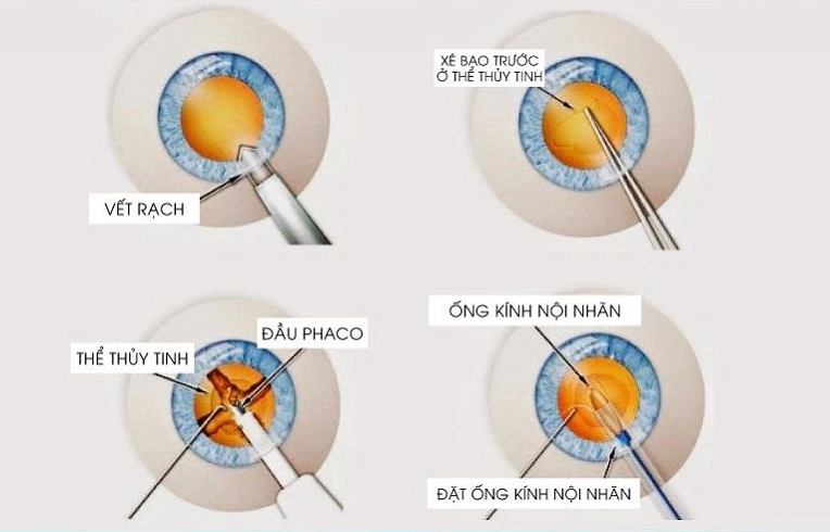 Hình ảnh minh họa quy trình mổ Phaco