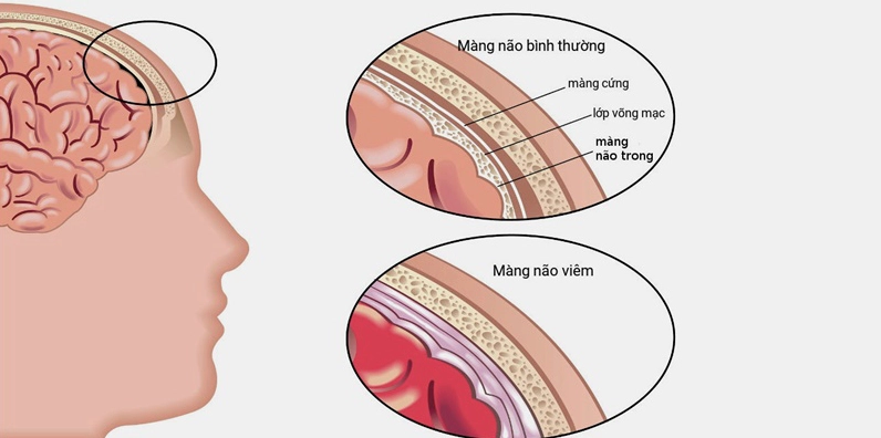 Hình ảnh minh họa vi khuẩn gây viêm màng não