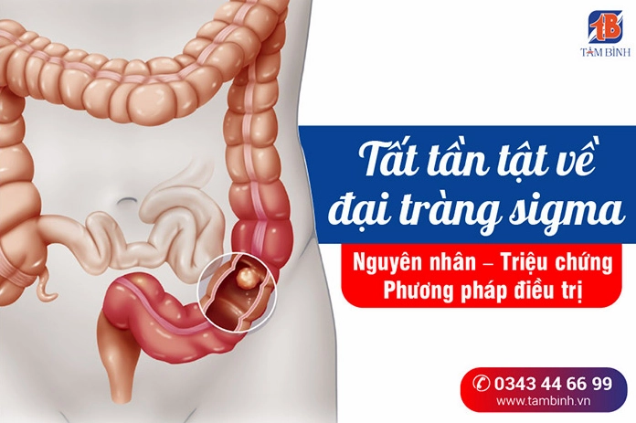 Hình ảnh minh họa viêm đại tràng sigma