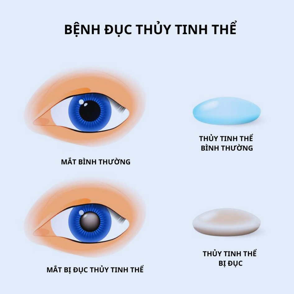 Hình ảnh một ca mổ cườm mắt thành công