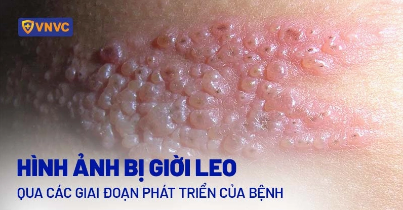 Hình ảnh mụn nước giai đoạn đầu của bệnh giời leo