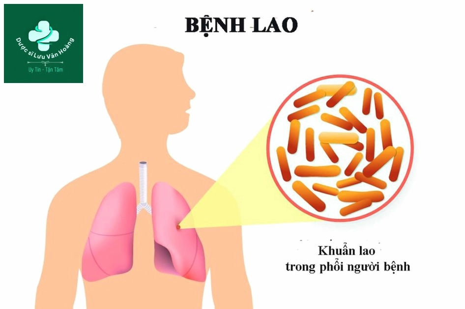 Hình ảnh vi khuẩn lao Mycobacterium tuberculosis