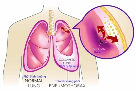 Hình ảnh X-quang phổi cho thấy tràn khí màng phổi