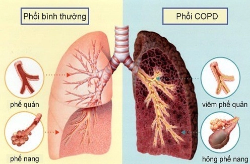 lao-phoi-la-gi-nguyen-nhan-trieu-chung-cach-phong-ngua-hieu-_316