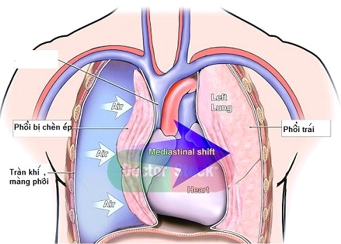 Minh họa giải phẫu khoang màng phổi và vị trí tràn khí