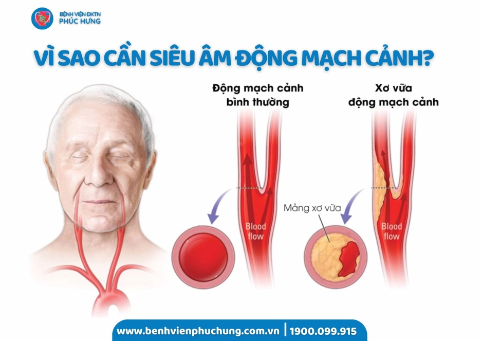 Minh họa đột quỵ