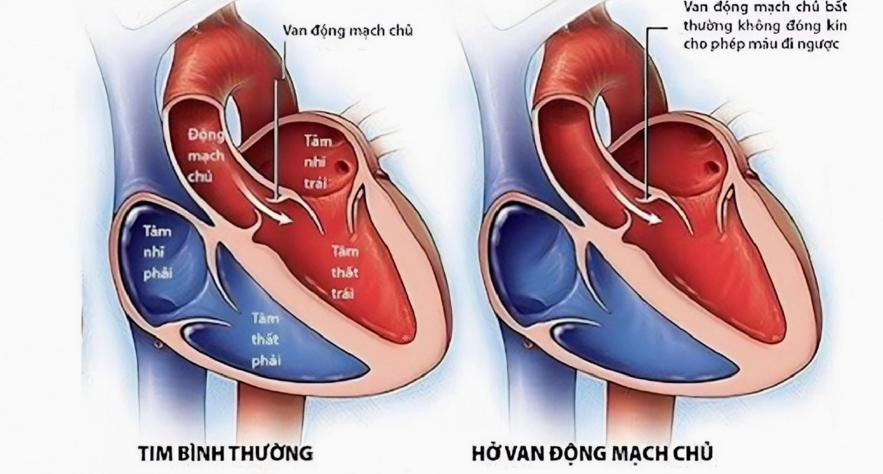 Minh họa quá trình bóc tách động mạch chủ