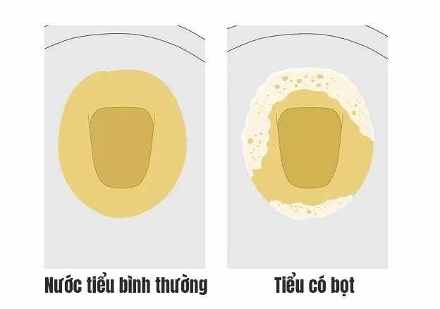Mô tả về protein trong nước tiểu