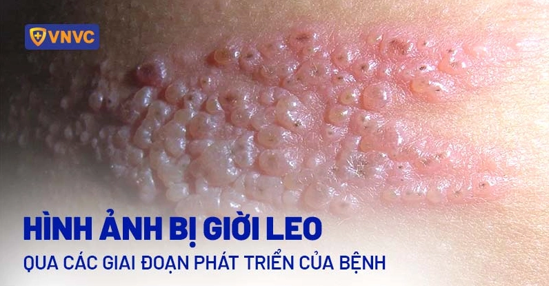 Mụn nước giời leo trên da