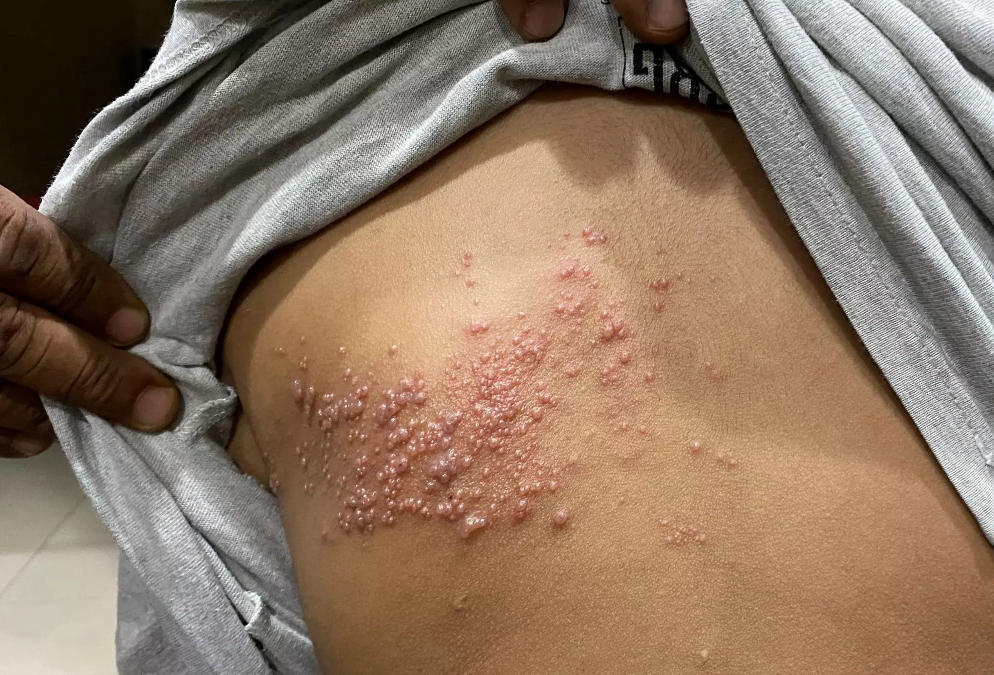 Người bệnh giời leo đang được chăm sóc