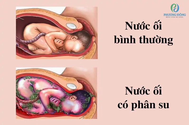 Nước ối có phân su