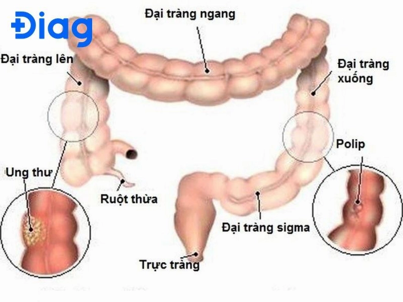 Phẫu thuật điều trị ung thư đại tràng sigma