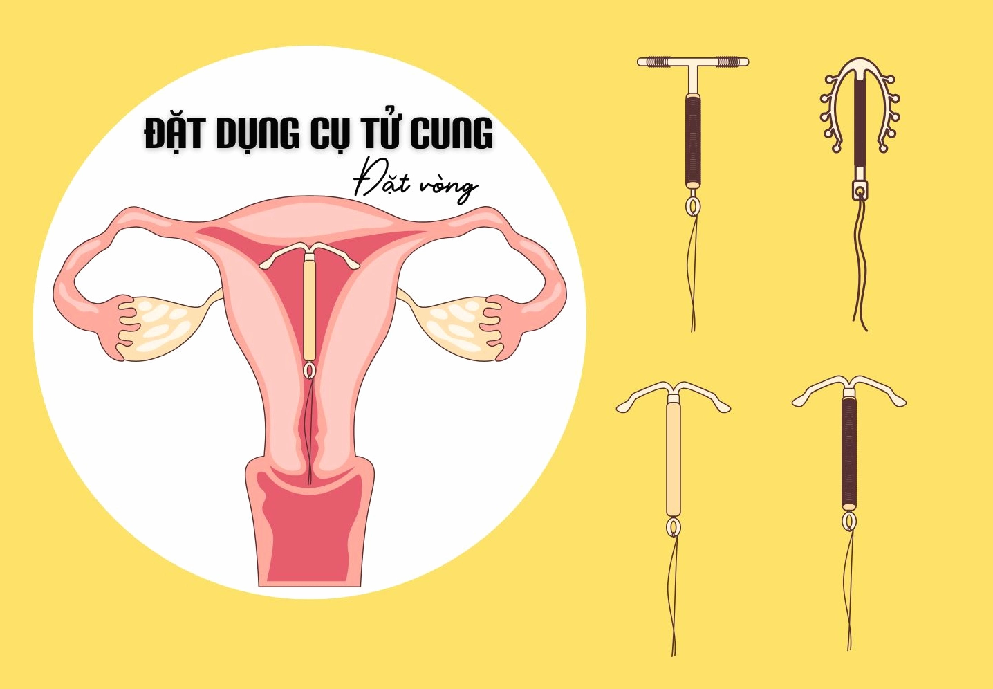 Phụ nữ sau khi đặt vòng tránh thai