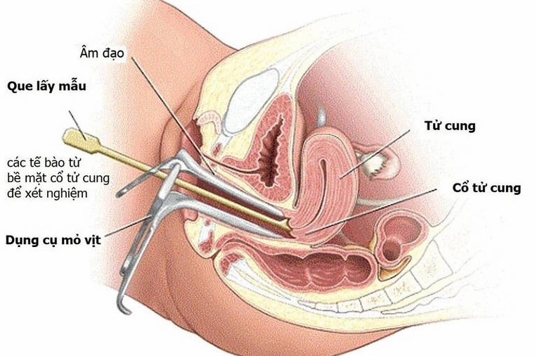 Quy trình khám phụ khoa với mỏ vịt