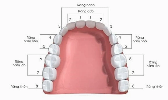 Răng khôn mọc lệch gây áp lực lên răng số 7