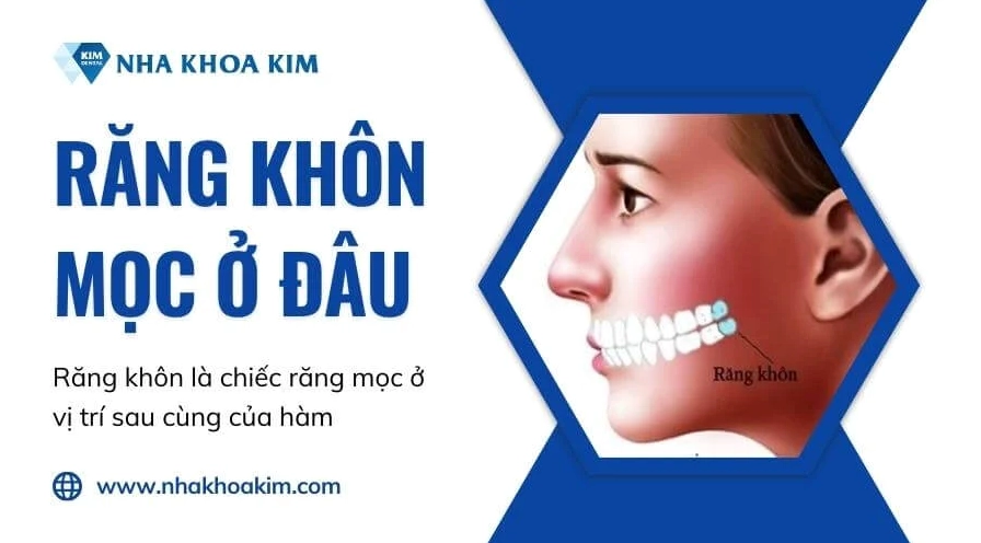 Răng khôn mọc sai vị trí gây nhiều biến chứng