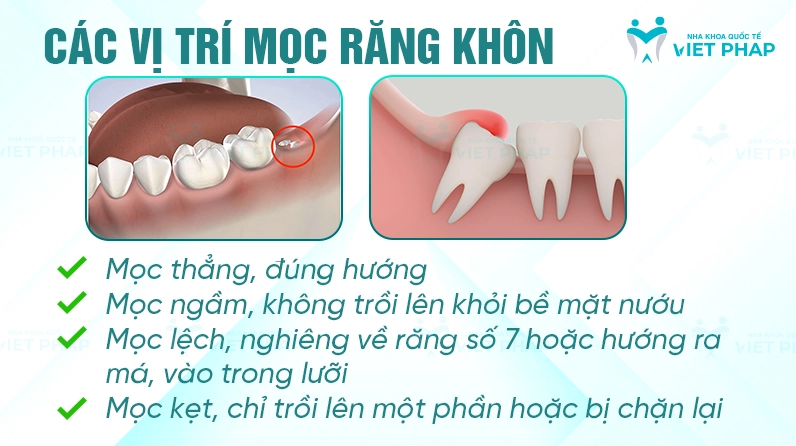 Sưng nướu do răng khôn mọc
