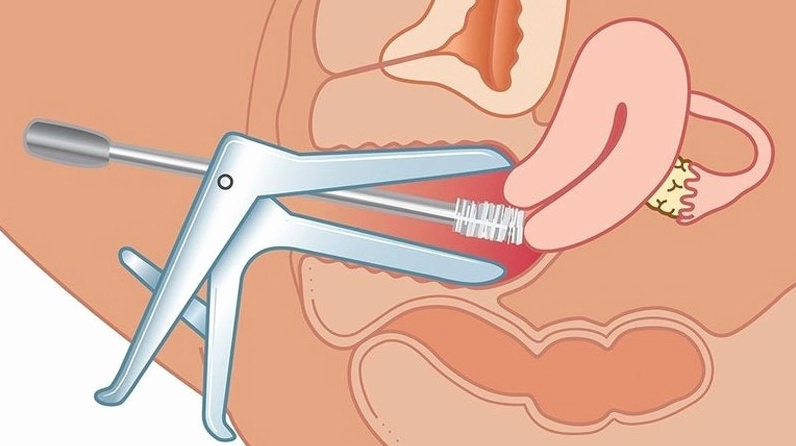 Thời điểm cần khám phụ khoa bằng mỏ vịt