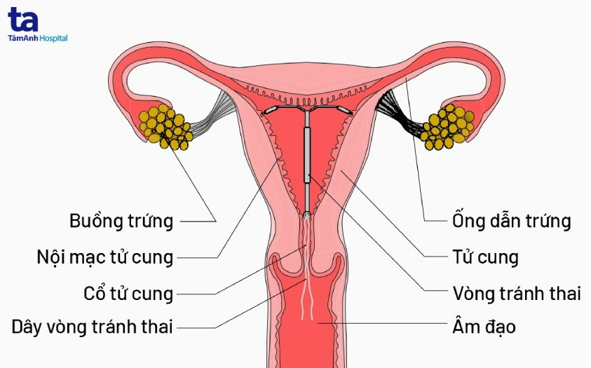 Tổng quan về đặt vòng tránh thai