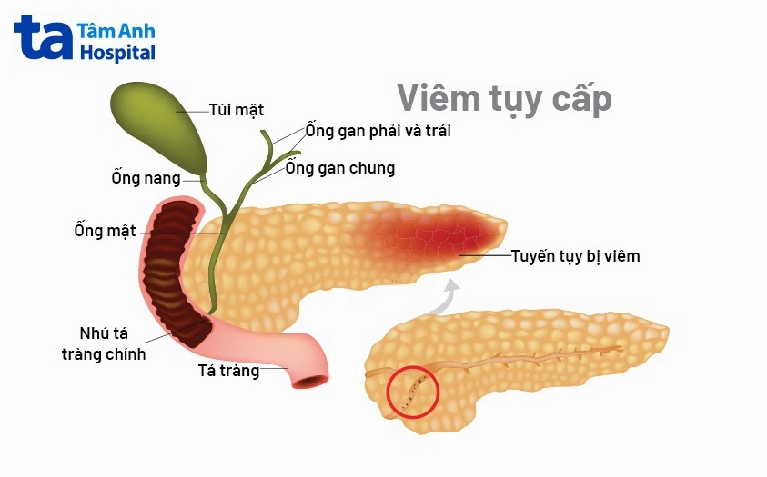 Triệu chứng viêm tụy cấp