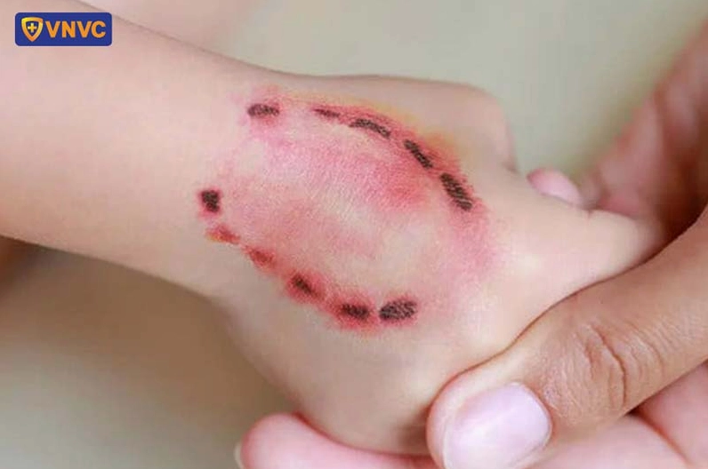 Vết cắn của chó có thể lây truyền virus dại nguy hiểm