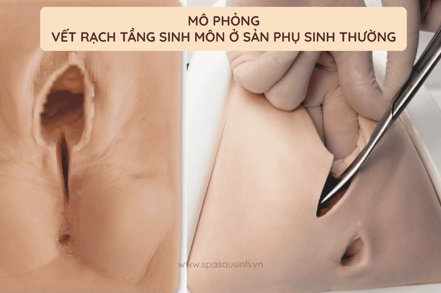 Vết rách tầng sinh môn khi sinh thường